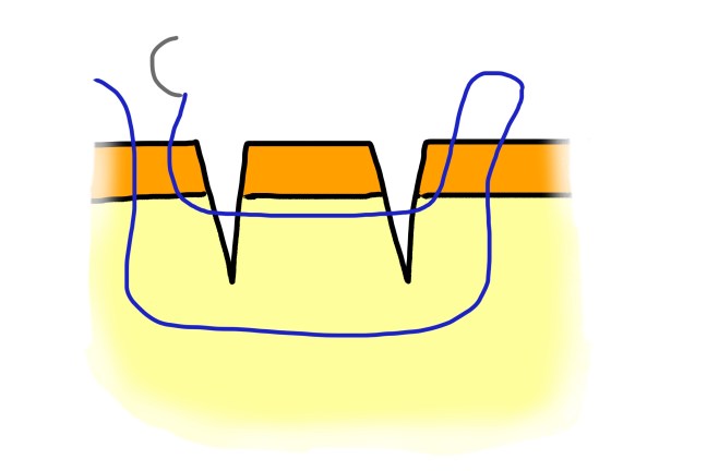 parallel lacerations vertmattressB