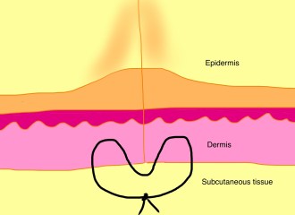 The set-back dermal suture