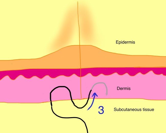 Set back dermal suture step 3b.jpg