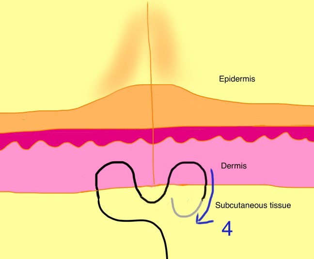 Set back dermal suture step 4.jpg