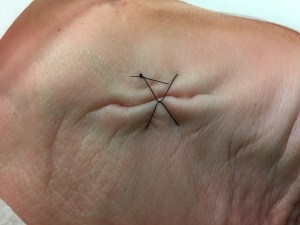 The Locked Horizontal Mattress Suture