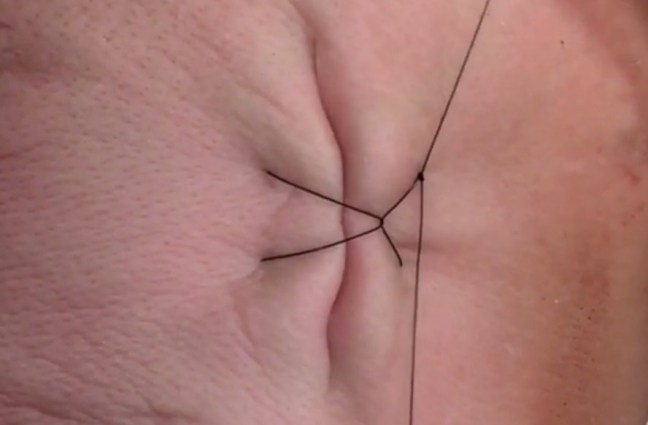 The Locked Horizontal Mattress is an alternative to the traditional technique, conferring additional advantages such as better wound edge apposition.