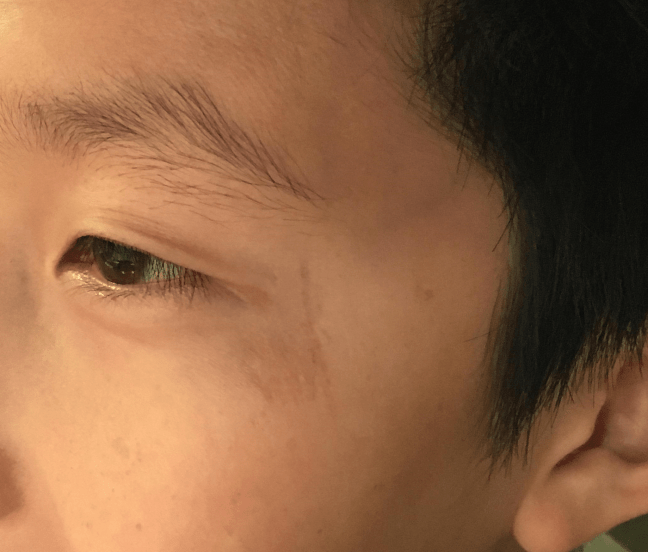 Here's the same patient from the opening image, revisited 3 years later. While a small scar persists on careful scrutiny, meticulous upfront wound care by the Emergency Physician (and careful attention to the wound by his parents) prevented him from developing a much more unsightly scar.