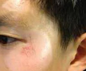 The patient's facial abrasion, pictured here at 3 months post injury. It's healing well--what did mom do along the way to get it here? And what needs to be done to ensure it looks even better as time passes?