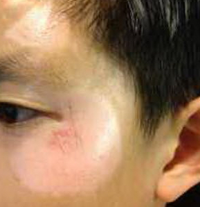 The patient's facial abrasion, pictured here at 3 months post injury. It's healing well--what did mom do along the way to get it here? And what needs to be done to ensure it looks even better as time passes?
